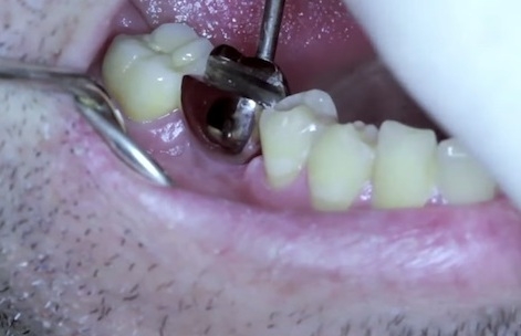 Sörnyitó kérdés megoldva