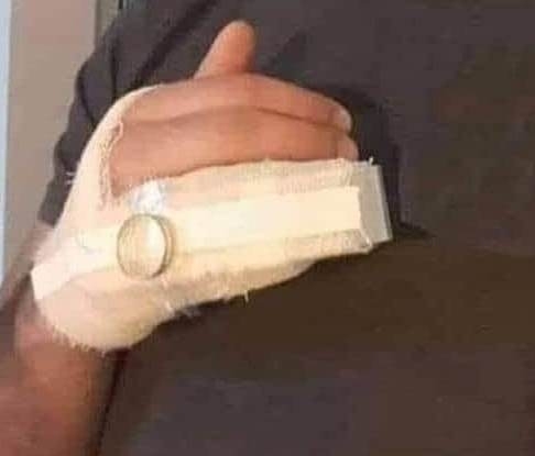 Amikor eltöröd az újjad, de a feleséged féltékeny típus